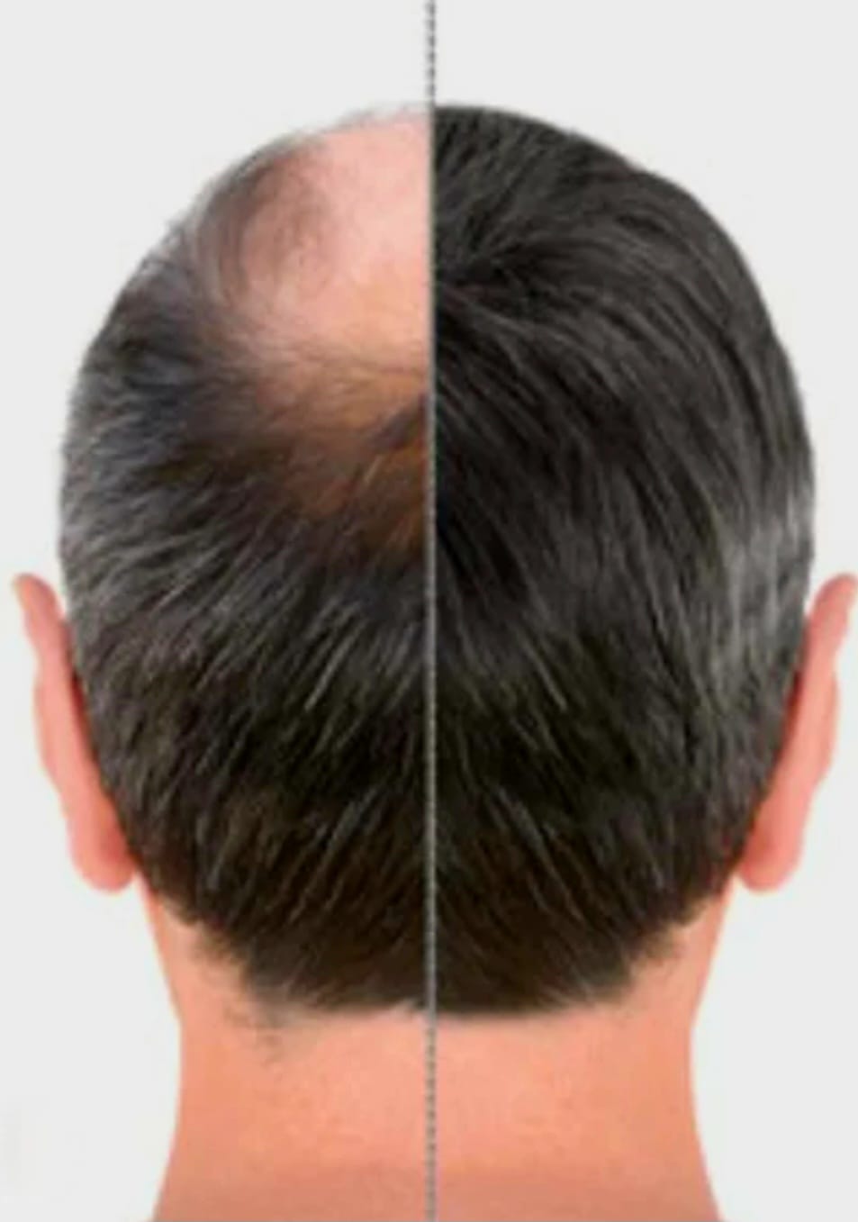 KIRKLAND Minoxidil 5% Extra Strength Men Hair Regrowth Solution, 6 Month Supply