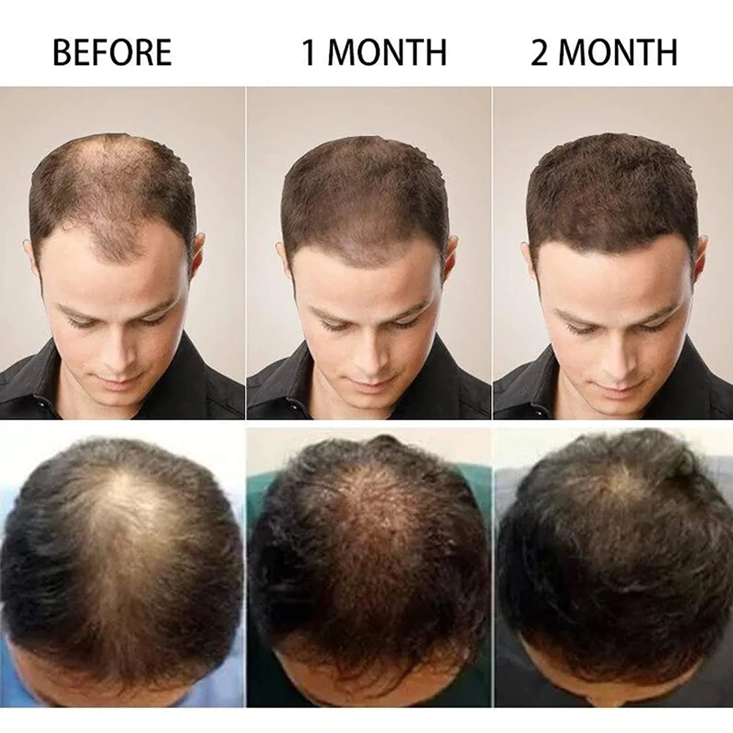 PURC High Hair Growth, Purc Oil for Hair Growth, HOVO Hair Density Essential Oil, Natural Hair Regrowth Serum, Anti-Frizz Hair Serum, Reduce Dry Hair Care Essential Oil for Women Men