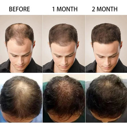 PURC High Hair Growth, Purc Oil for Hair Growth, HOVO Hair Density Essential Oil, Natural Hair Regrowth Serum, Anti-Frizz Hair Serum, Reduce Dry Hair Care Essential Oil for Women Men