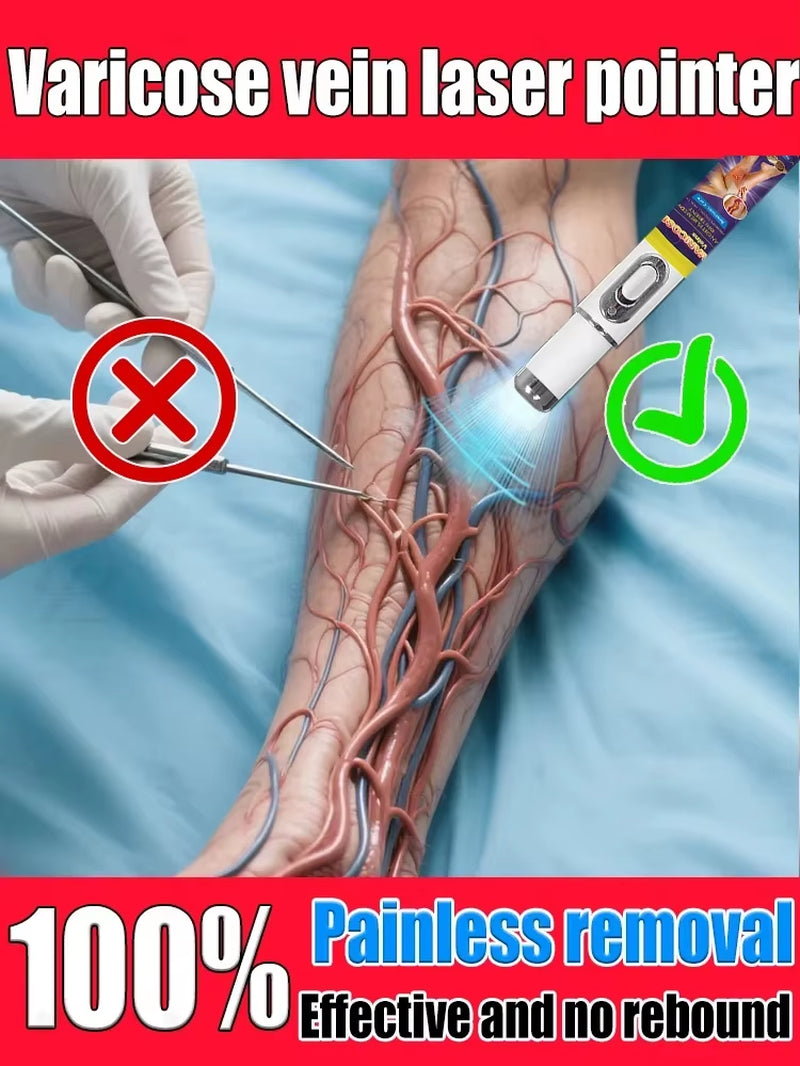 Le Nouveau Laser Pour Varices Élimine La Vascularite Et La Phlébite, Soulage La Douleur Des Jambes D'Araignée, Thérapie Par